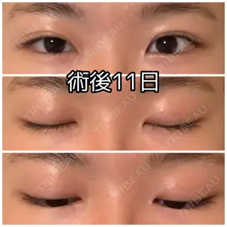 11日目の経過画像（1枚目）