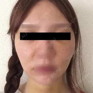 1日目の経過画像（1枚目）