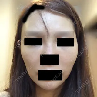14日目の経過画像（1枚目）