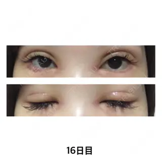 16日目の経過画像（1枚目）