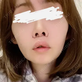 0日目の経過画像（1枚目）
