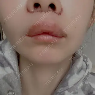 1日目の経過画像（1枚目）
