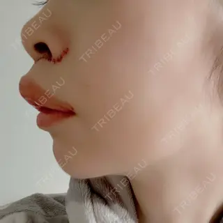 1日目の経過画像（2枚目）