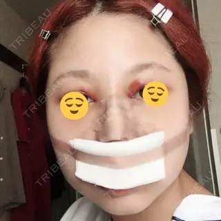 3日目の経過画像（1枚目）