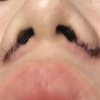 6日目の経過画像（1枚目）