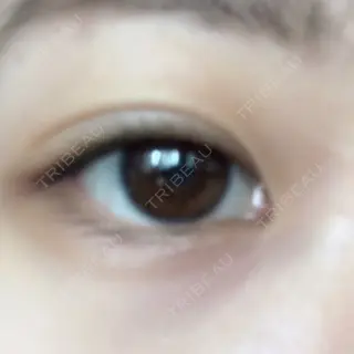 6日目の経過画像（1枚目）
