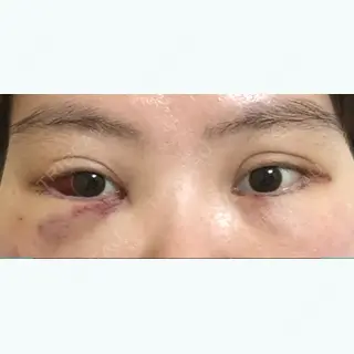 2日目の経過画像（1枚目）