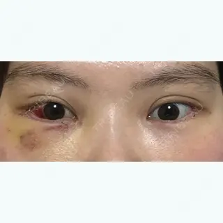 5日目の経過画像（1枚目）