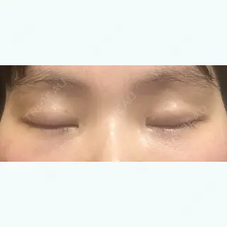 18日目の経過画像（2枚目）