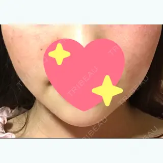29日目の経過画像（1枚目）