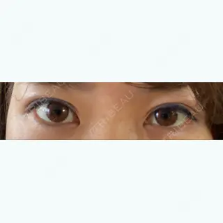 34日目の経過画像（1枚目）