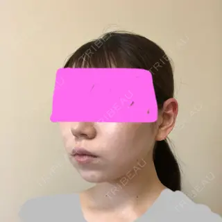 34日目の経過画像（2枚目）
