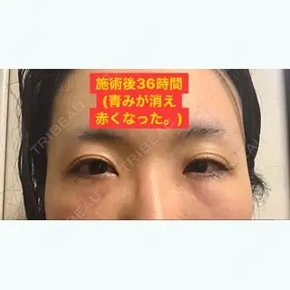 3日目の経過画像（1枚目）