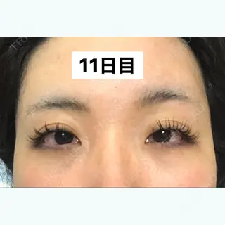 11日目の経過画像（1枚目）