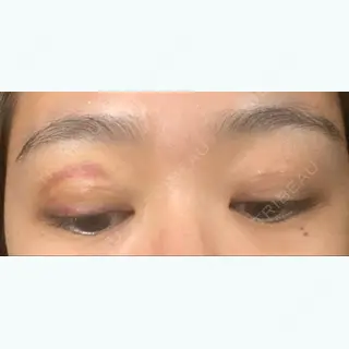 5日目の経過画像（3枚目）