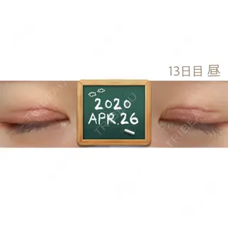 13日目の経過画像（2枚目）