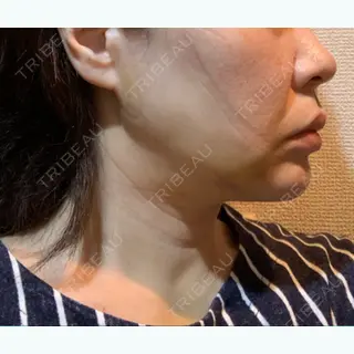 13日目の経過画像（2枚目）