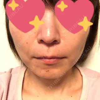 4日目の経過画像（1枚目）