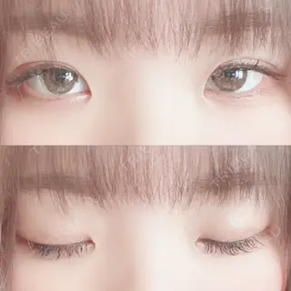 13日目の経過画像（1枚目）