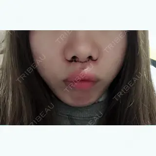 1日目の経過画像（2枚目）