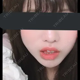 15日目の経過画像（1枚目）