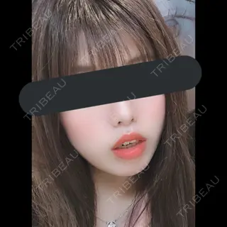 82日目の経過画像（2枚目）