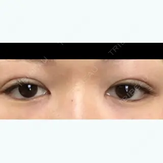 2日目の経過画像（1枚目）