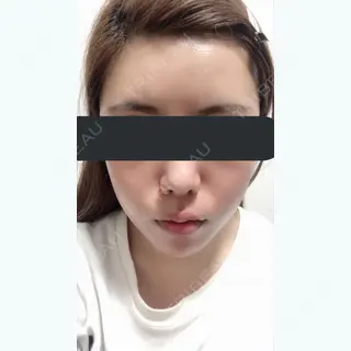 62日目の経過画像（1枚目）