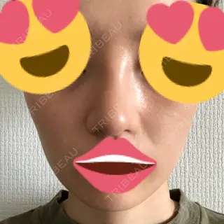 8日目の経過画像（1枚目）