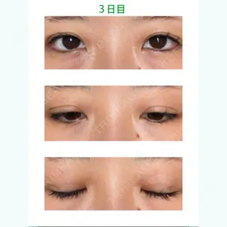 3日目の経過画像（1枚目）