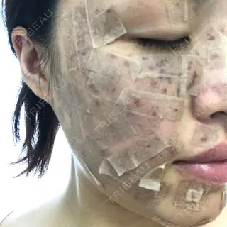1日目の経過画像（2枚目）