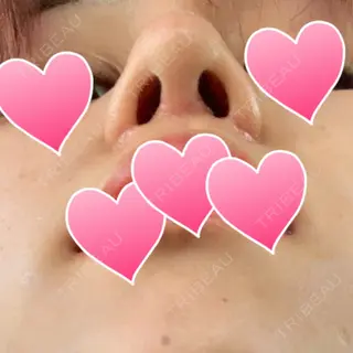 18日目の経過画像（3枚目）