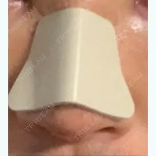 2日目の経過画像（1枚目）