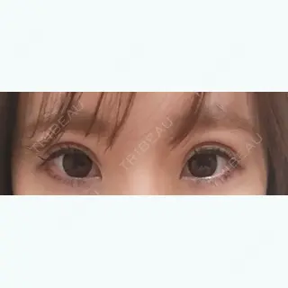 8日目の経過画像（1枚目）