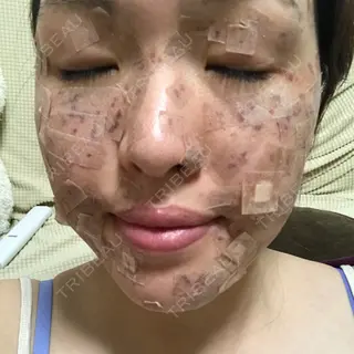 2日目の経過画像（1枚目）