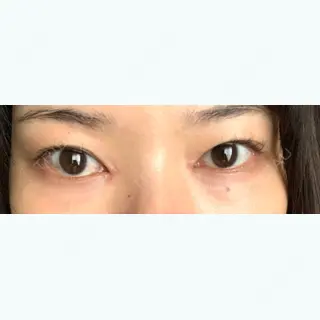 14日目の経過画像（1枚目）