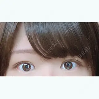 93日目の経過画像（1枚目）