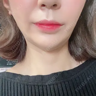 65日目の経過画像（3枚目）