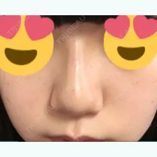 5日目の経過画像（2枚目）