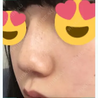 5日目の経過画像（3枚目）