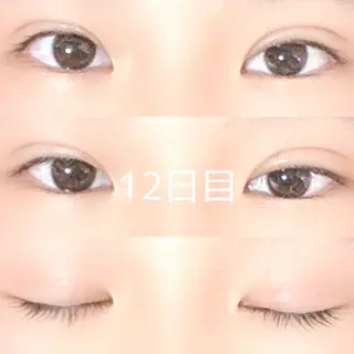 12日目の経過画像（1枚目）