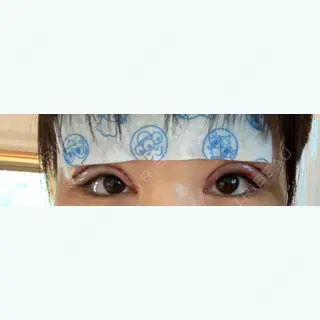 1日目の経過画像（1枚目）