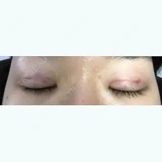 1日目の経過画像（2枚目）