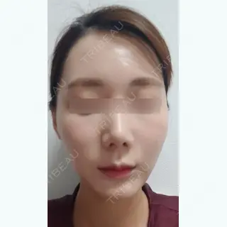 15日目の経過画像（1枚目）