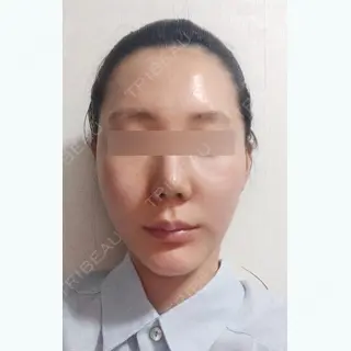 32日目の経過画像（1枚目）