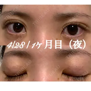 31日目の経過画像（3枚目）