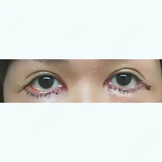 1日目の経過画像（1枚目）