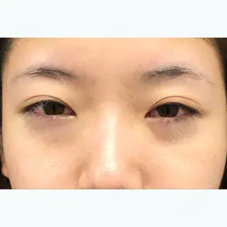 0日目の経過画像（1枚目）