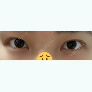 93日目の経過画像（2枚目）