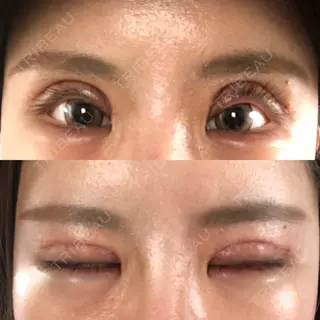 6日目の経過画像（1枚目）